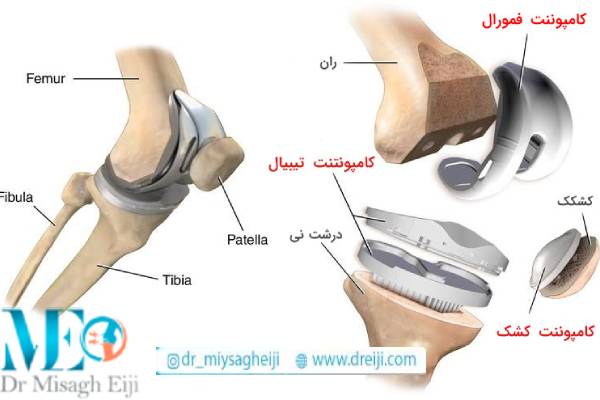 انواع پروتزهای زانو
