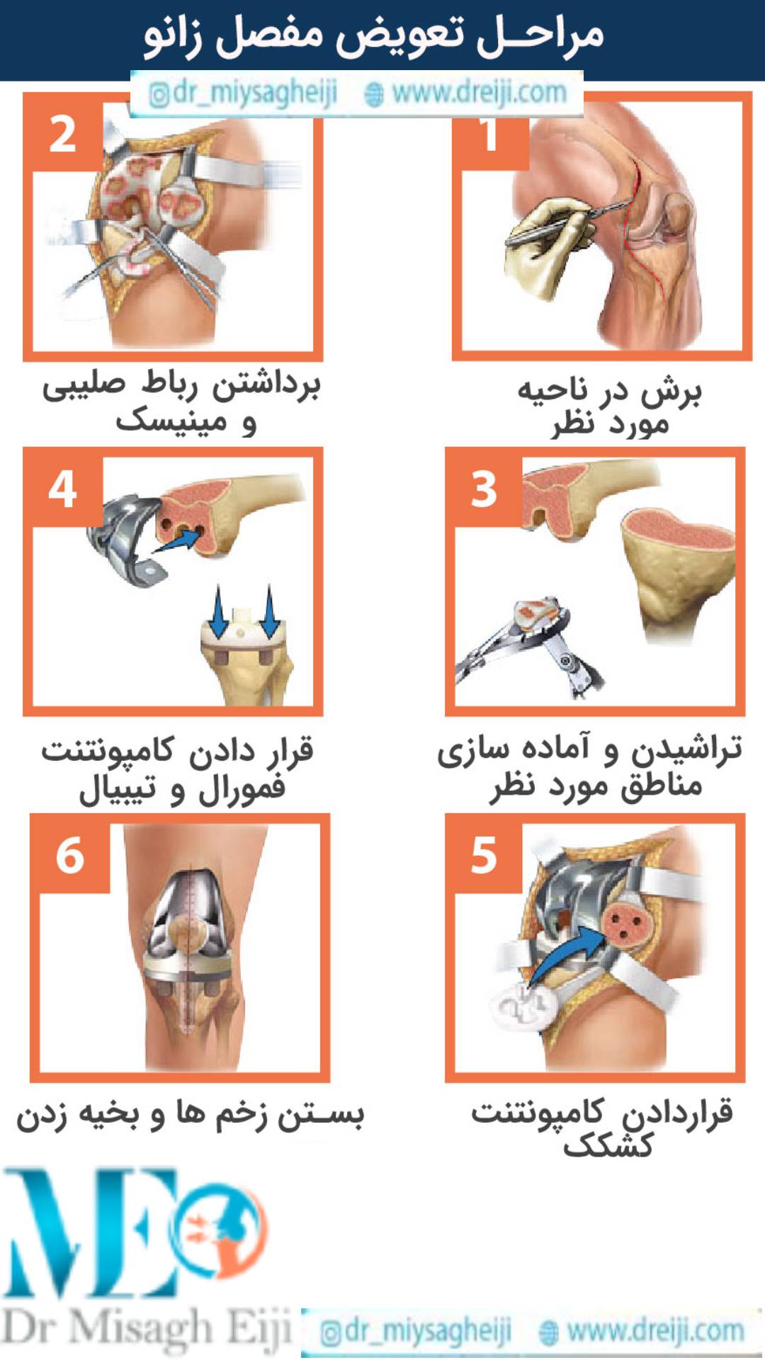 مراحل تعویض مفصل زانو