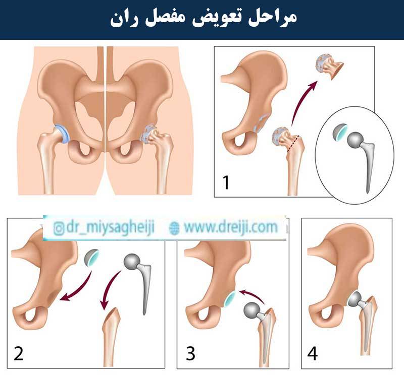 مراحل تعویض مفصل لگن