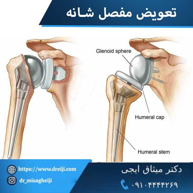 تعویض مفصل شانه