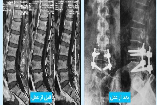 شکستگی مهره کمر