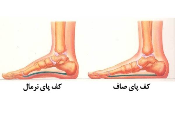 صافی کف پا 