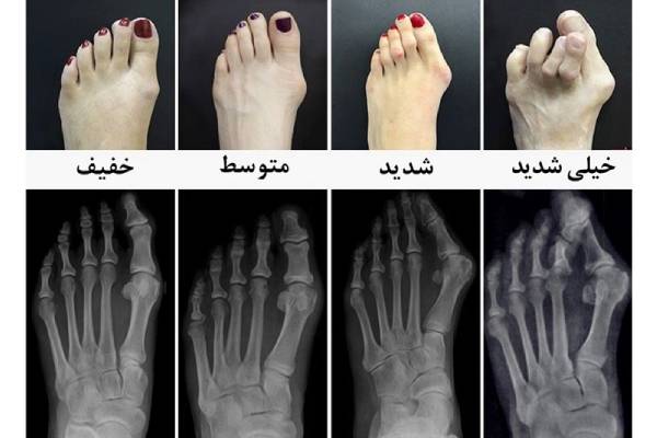 هالوکس والگوس