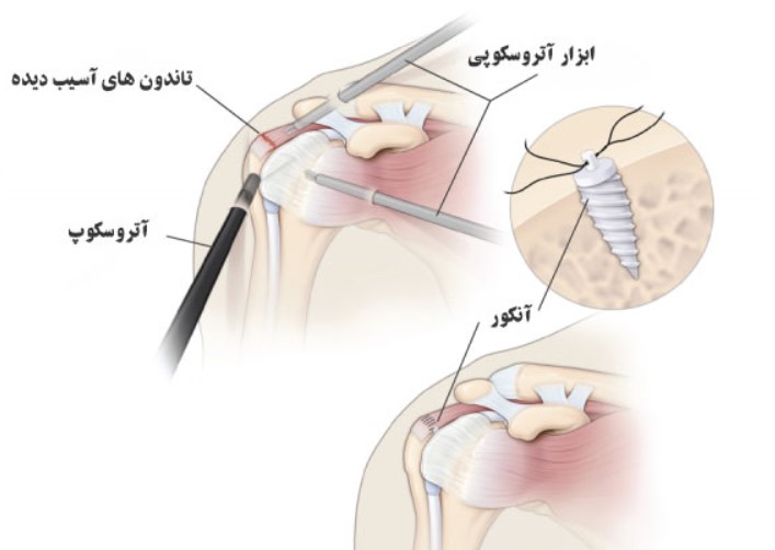 دررفتگی مکرر شانه