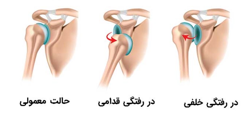 دررفتگی مکرر شانه