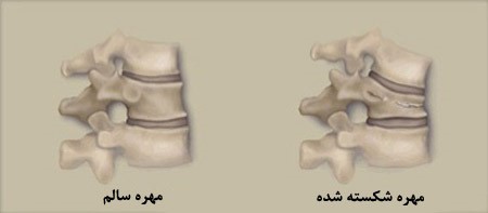 شکستگی مهره کمر