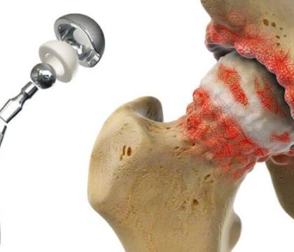 فعالیت پس از عمل تعویض کامل لگن