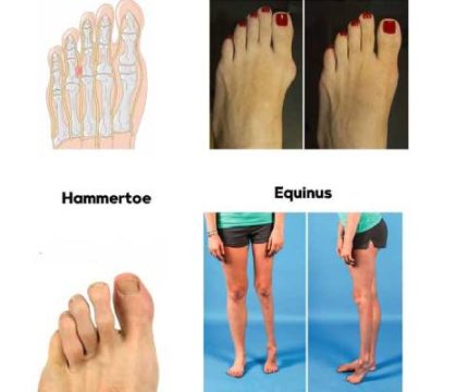 عوارض کفش پاشنه بلند