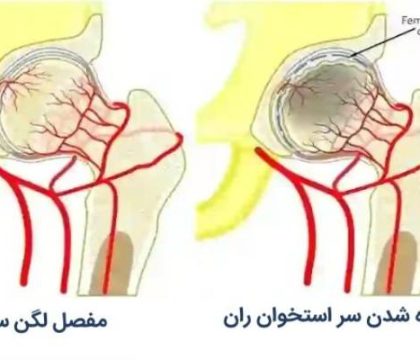 سیاه شدن سر استخوان ران یا نکروز آواسکولار