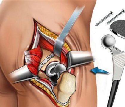 Hip Replacement