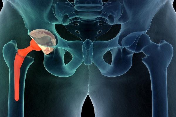 Hip Replacement