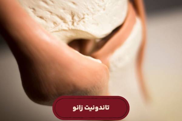 تاندونیت زانو
